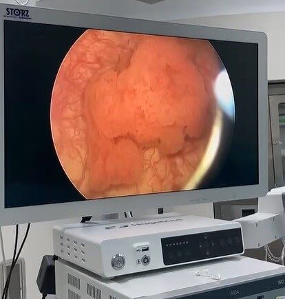 Bayburt Devlet Hastanesi üroloji kliniğinde farklı rahatsızlıkları bulunan 6 hasta,