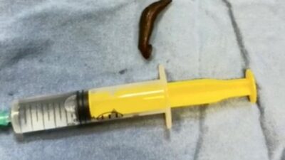Çorum’da şiddetli boğaz ağrısı, yutma güçlüğü ve kan tükürme gibi