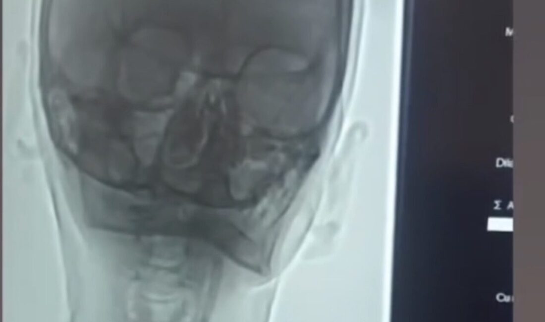 Iğdır’da şah damarı darlığı bulunan hastaya stent takıldı. Hasta, tedavisinin