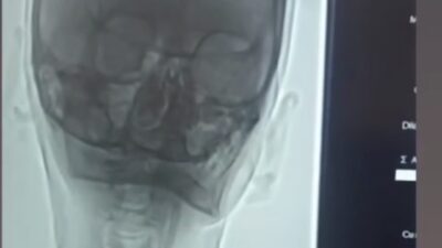 Iğdır’da şah damarı darlığı bulunan hastaya stent takıldı. Hasta, tedavisinin